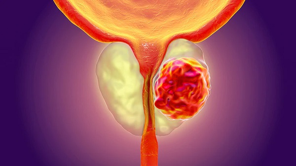 Symptoms of prostate cancer